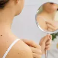 melanoma-skin-self-examination