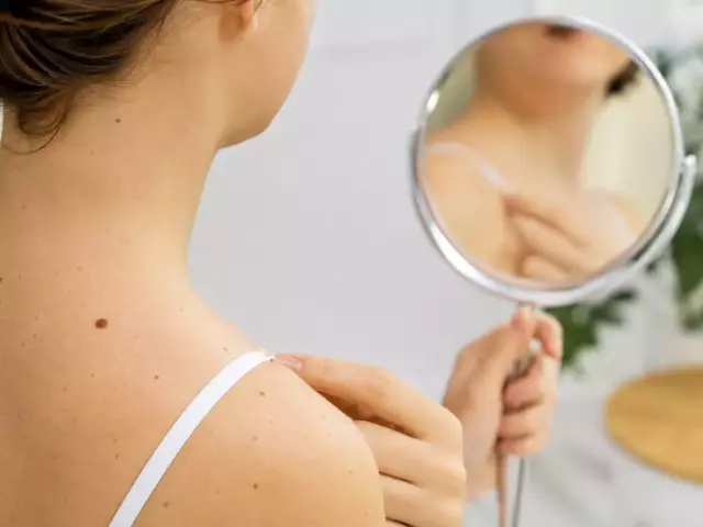melanoma-skin-self-examination